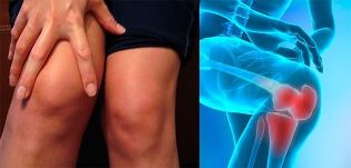 Dyskomfort i obrzęk okolicy kolana to pierwsze objawy artrozy